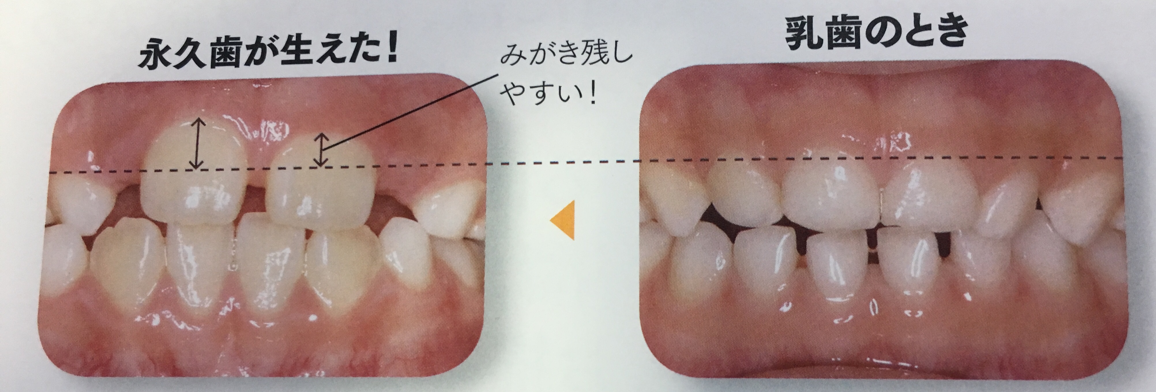 子供 の 歯 生え 変わり